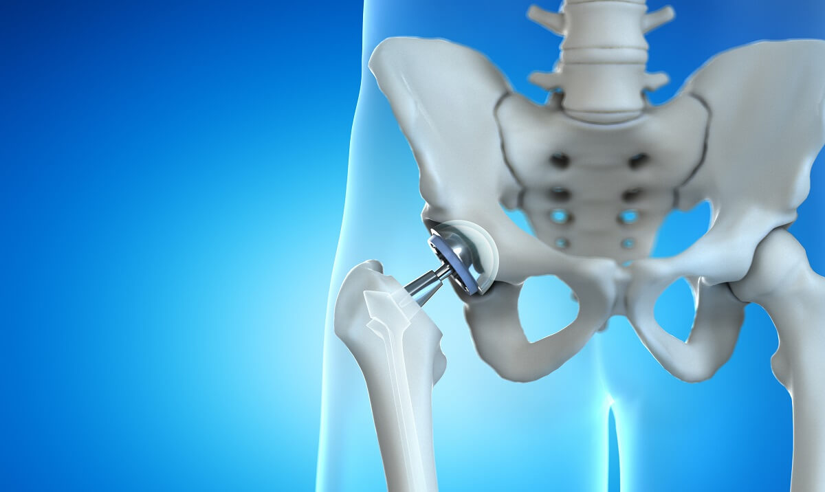 Studies Confirm Benefits of Direct Anterior Approach to Total Hip  Replacement - OrthoMaryland